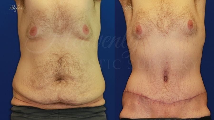Plastic Surgery, plastic surgeon, tummy tuck, abdominoplasty, weight loss Plastic Surgery, plastic surgeon, tummy tuck, abdominoplasty, weight loss