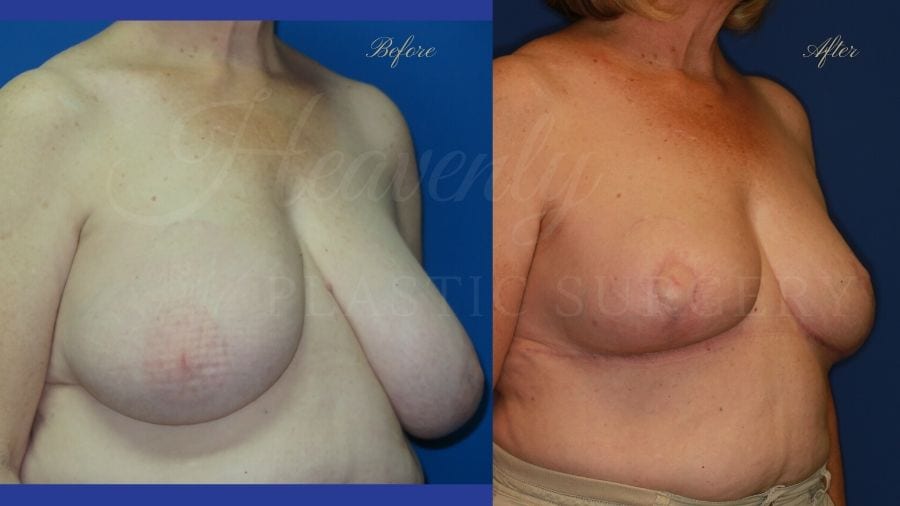 Plastic surgery, plastic surgeon, breast reduction, breast lift, reduction mammaplasty, mastopexy, before and after