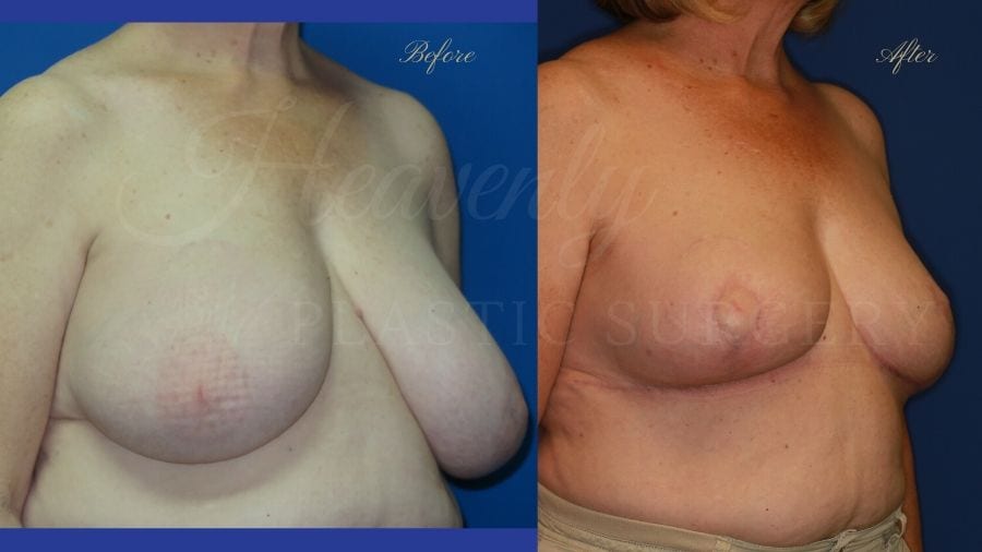 Plastic surgery, plastic surgeon, breast reduction, breast lift, reduction mammaplasty, mastopexy, before and after Plastic surgery, plastic surgeon, breast reduction, breast lift, reduction mammaplasty, mastopexy, before and after