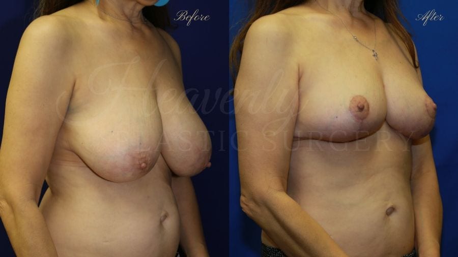 Plastic surgery, plastic surgeon, before and after breast reduction, breast lift, mastopexy, reduction mammaplasty