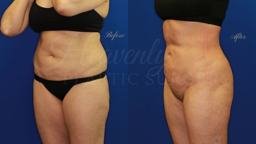 Plastic surgery, plastic surgeon, liposuction abdomen flanks thighs back Plastic surgery, plastic surgeon, liposuction abdomen flanks thighs back