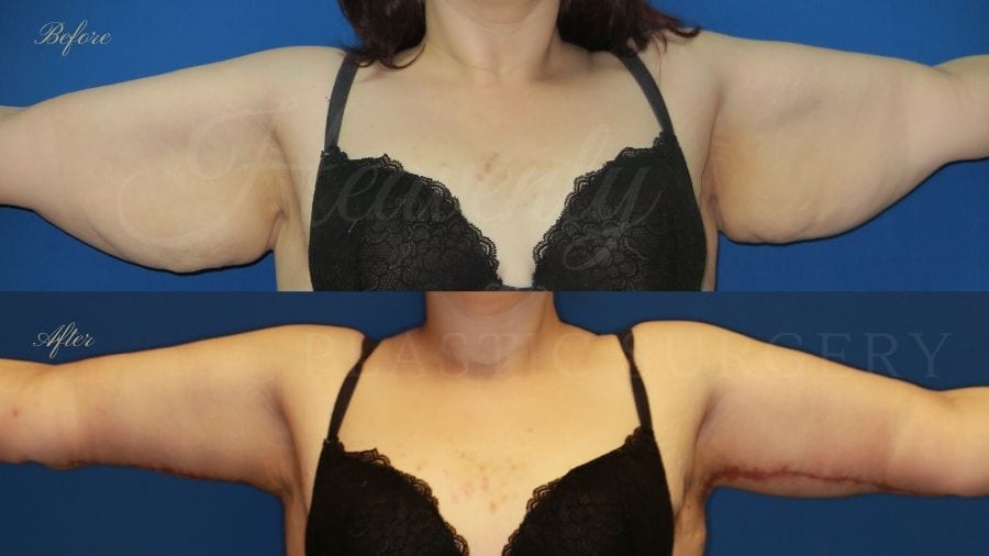 Arm lift, Brachioplasty, plastic surgery, plastic surgeon, massive weight loss