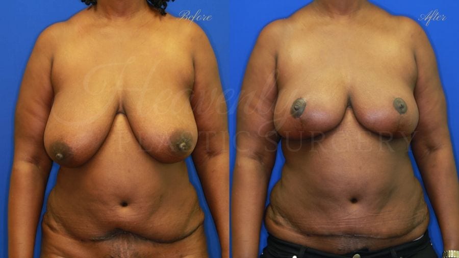 Plastic surgery, plastic surgeon, mommy Makeover, Breast reduction, reduction mammaplasty, Tummy Tuck, Abdominoplasty, Liposuction, Breast Lift, Mastopexy. before and after