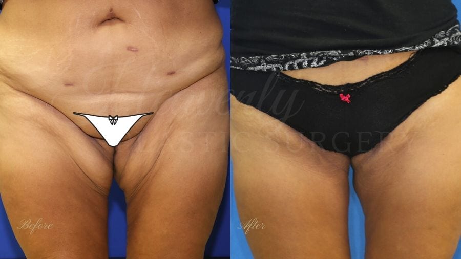 Plastic surgery, plastic surgeon, before and after thigh lift, thigh lift, thighplasty