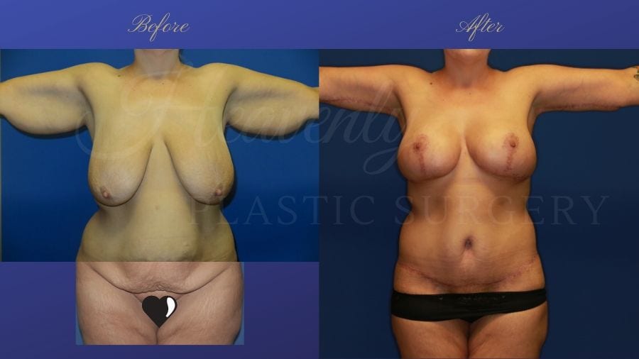 Mommy Makeover - Brachioplasty (Arm Lift), Breast Lift (Mastopexy) Breast Implants (330cc SRM silicone implants under the muscle), Body Lift, Liposuction