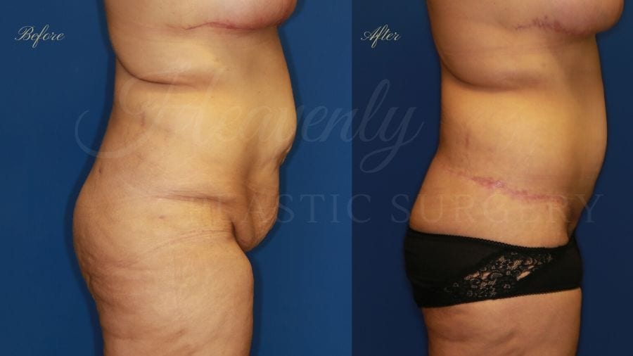 Tummy Tuck, Abdominoplasty, Liposuction, before and after bodylift, plastic surgery, plastic surgeon, bodylift