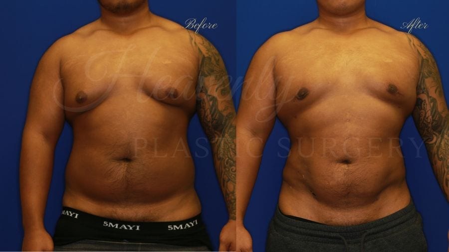 Plastic surgery, plastic surgeon, liposuction abdomen flanks back, lipoetching abdomen