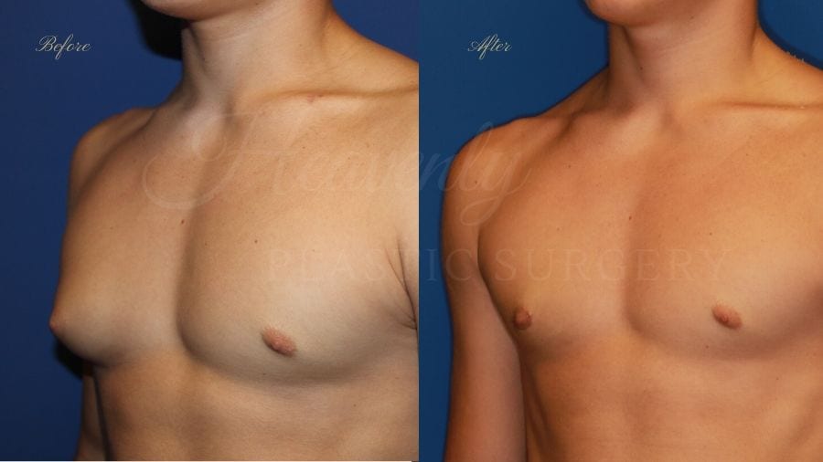 Plastic surgery, plastic surgeon, gynecomastia excision, man boobs