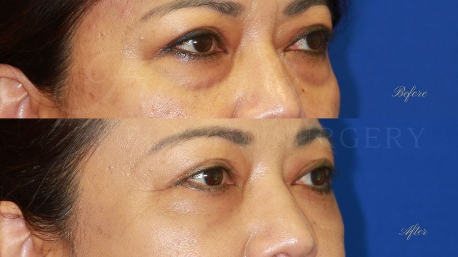 Plastic surgeon, plastic surgery, lower blepharoplasty, eyelid surgery, treating eyelid bags and dark circles under eyes