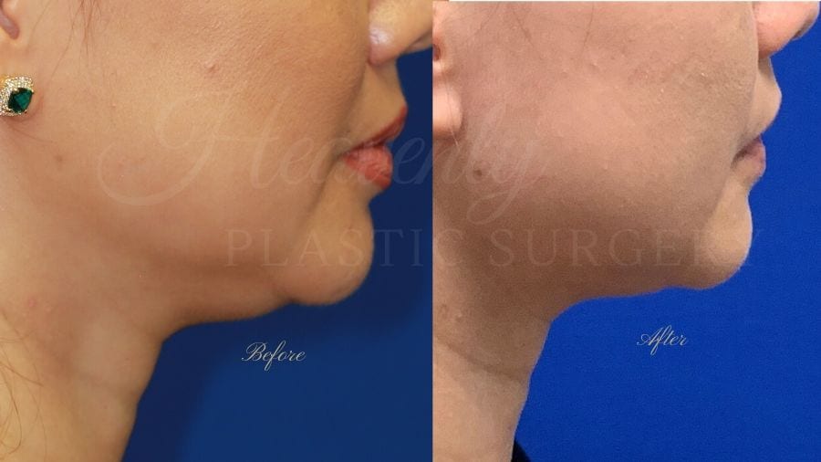 Plastic surgery, plastic surgeon, injectables, Kybella, submental fat