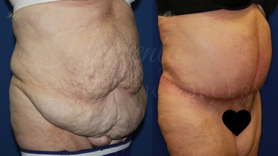 tummy tuck, abdominoplasty, panniculectomy, plastic surgery, plastic surgeon tummy tuck, abdominoplasty, panniculectomy, plastic surgery, plastic surgeon