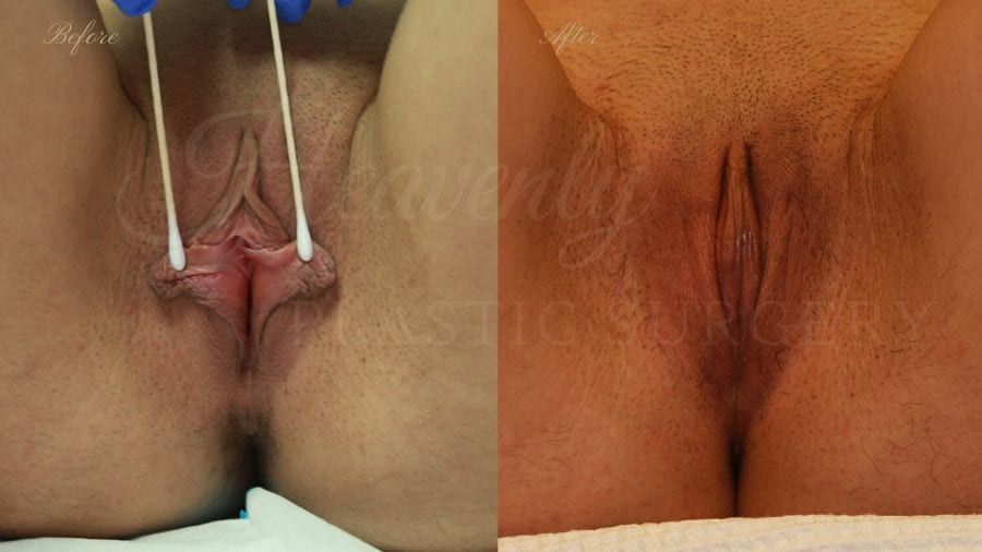 Labiaplasty, vaginal surgery, vaginal rejuvenation, vaginal reconstruction