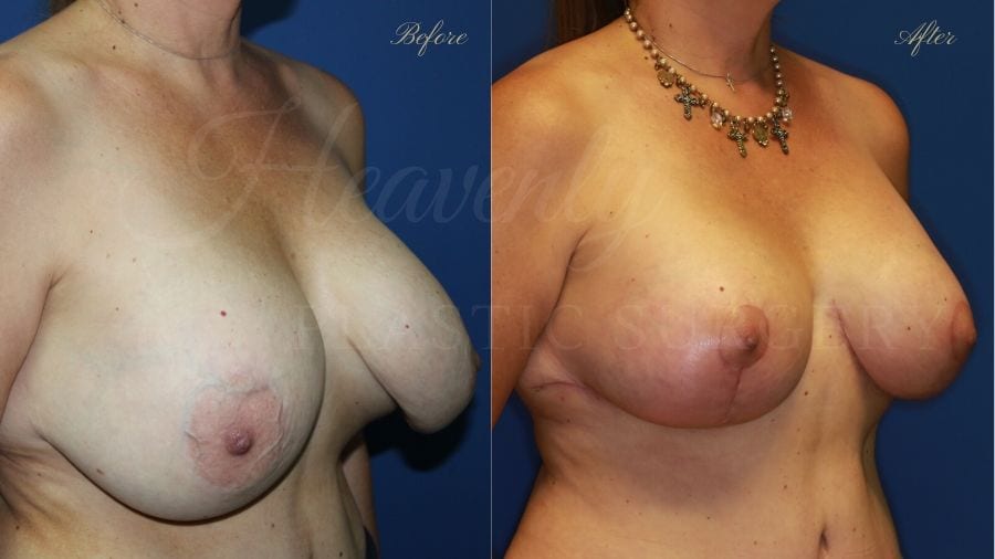 Breast Implant Exchange and Breast Lift - 310cc SRM Silicone Implants with Wise pattern Mastopexy (Anchor Scar), capsular contracture, breast implant rupture