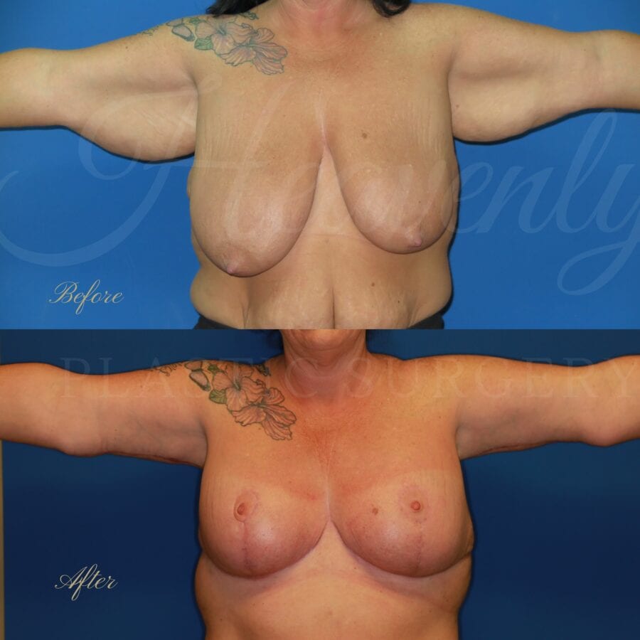 Plastic surgery, plastic surgeon, arm lift, breast lift, breast reduction, brachioplasty
