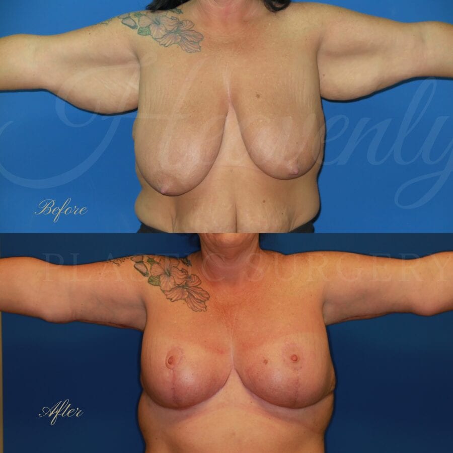 Plastic surgery, plastic surgeon, arm lift, breast lift, breast reduction, brachioplasty Plastic surgery, plastic surgeon, arm lift, breast lift, breast reduction, brachioplasty