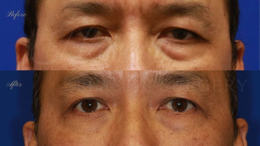 Plastic surgeon, plastic surgery, lower blepharoplasty, eyelid surgery, treating eyelid bags and dark circles under eyes