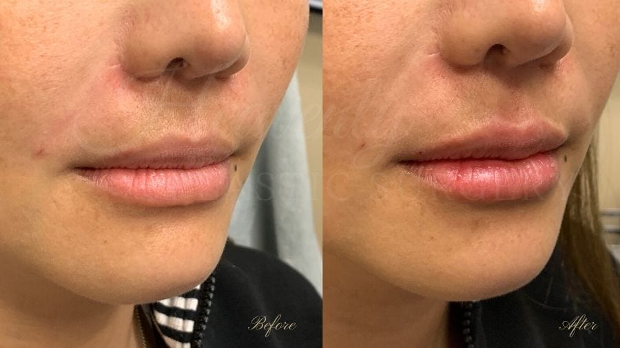 Lip filler, lip injection, juvederm, volbella, bigger lips, more lip volume