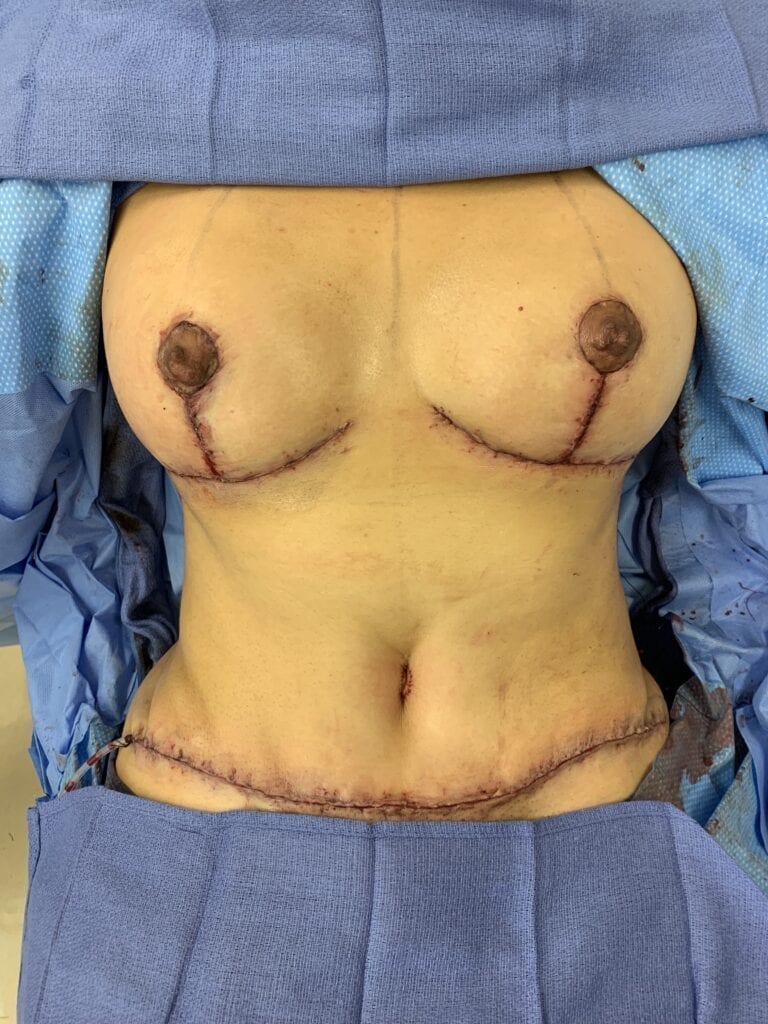 Completed tummy tuck and Mommy Makeover)