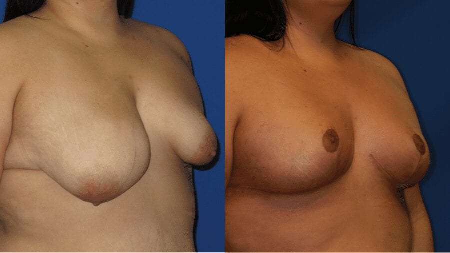Plastic surgery, plastic surgeon, before and after breast lift, breast lift, mastopexy