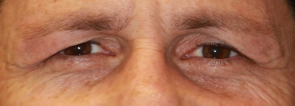 sagging old eyelid skin