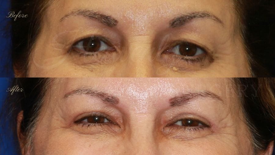 Plastic surgeon, plastic surgery, upper blepharoplasty, eyelid surgery