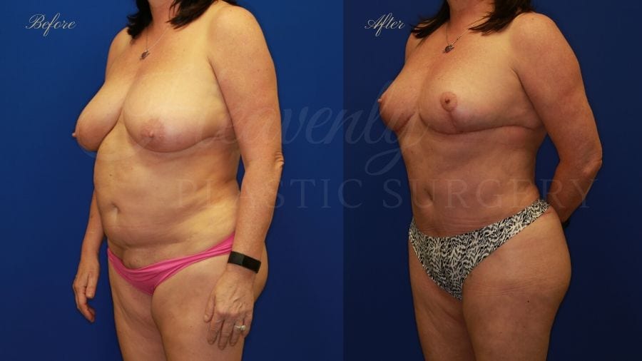 Plastic surgery, plastic surgeon, mommy Makeover, Breast reduction, reduction mammaplasty, Tummy Tuck, Abdominoplasty, Liposuction, Breast Lift, Mastopexy. before and after
