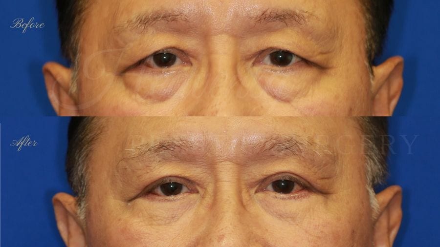 Plastic surgeon, plastic surgery, upper blepharoplasty, eyelid surgery Plastic surgeon, plastic surgery, upper blepharoplasty, eyelid surgery
