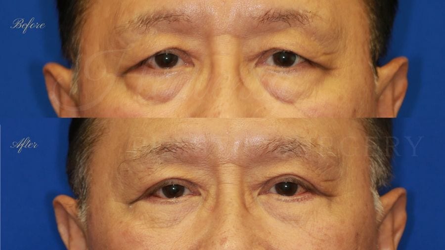 Plastic surgeon, plastic surgery, upper blepharoplasty, eyelid surgery