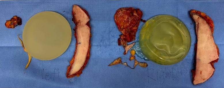 ruptured implant with breast tissue, breast implant removal, breast explantation
