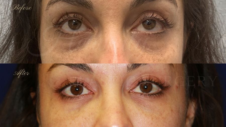 tear trough fillers, dark circles, sunken eyes, eyebags, vollure, volbella tear trough fillers, dark circles, sunken eyes, eyebags, vollure, volbella
