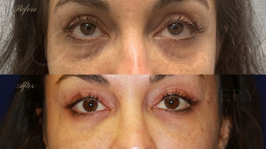 tear trough fillers, dark circles, sunken eyes, eyebags, vollure, volbella