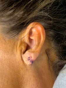 Plastic Surgery, Plastic Surgeon, Earlobe Repair, Torn Ear, Orange County, Lake Forest, Guaged Ear