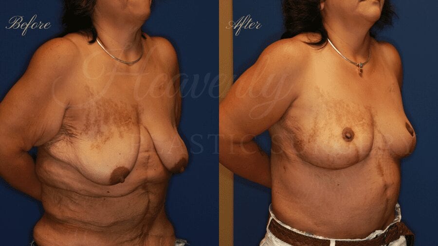 Tummy Tuck, Abdominoplasty, Liposuction, before and after bodylift, plastic surgery, plastic surgeon, bodylift, upper body lift, breast lift