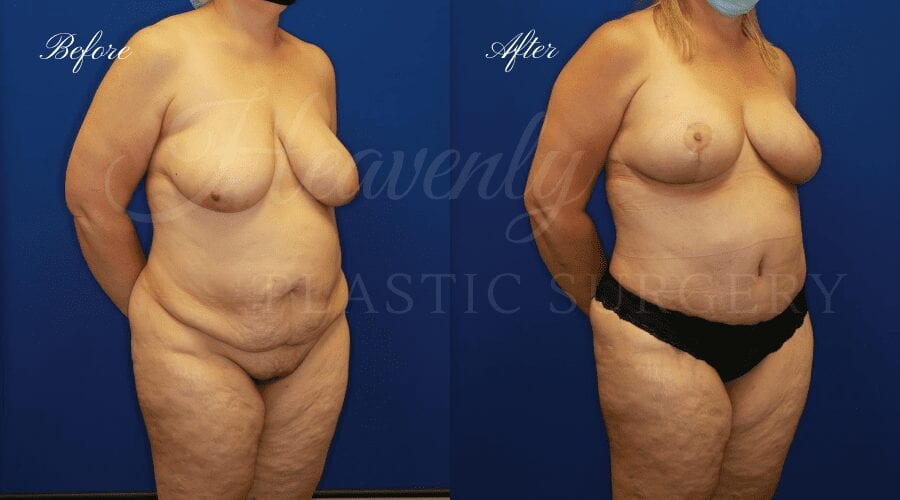Plastic Surgery, Plastic Surgeon, Breast Lift, Mastopexy, Tummy Tuck, Excess Skin, Skin, Fat, Arm Lift, Bat Wings, Mommy Makeover
