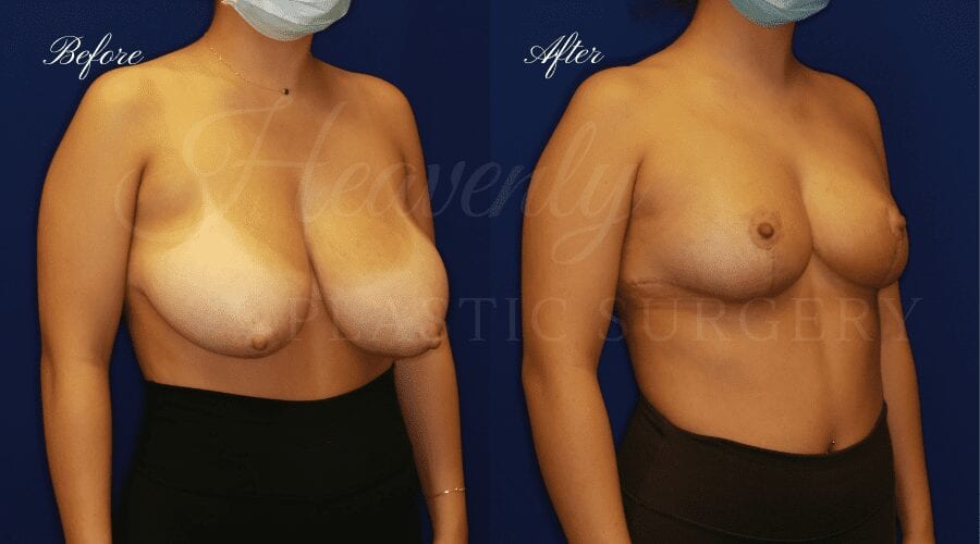 Breast Reduction Before and After, Plastic surgery, plastic surgeon, breast reduction, breast lift, reduction mammaplasty, mastopexy, before and after, mastopexy Breast Reduction Before and After, Plastic surgery, plastic surgeon, breast reduction, breast lift, reduction mammaplasty, mastopexy, before and after, mastopexy
