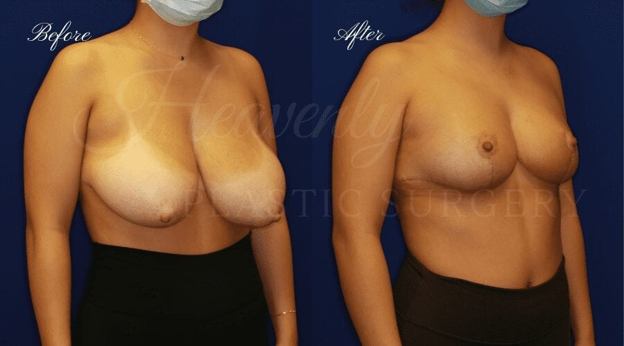 Breast Reduction Before and After, Plastic surgery, plastic surgeon, breast reduction, breast lift, reduction mammaplasty, mastopexy, before and after, mastopexy