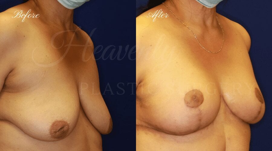 Plastic Surgery, Plastic Surgeon, Breast Lift, Mastopexy, Donut Scar, Breast Lift Before and After, Mastopexy Before and After