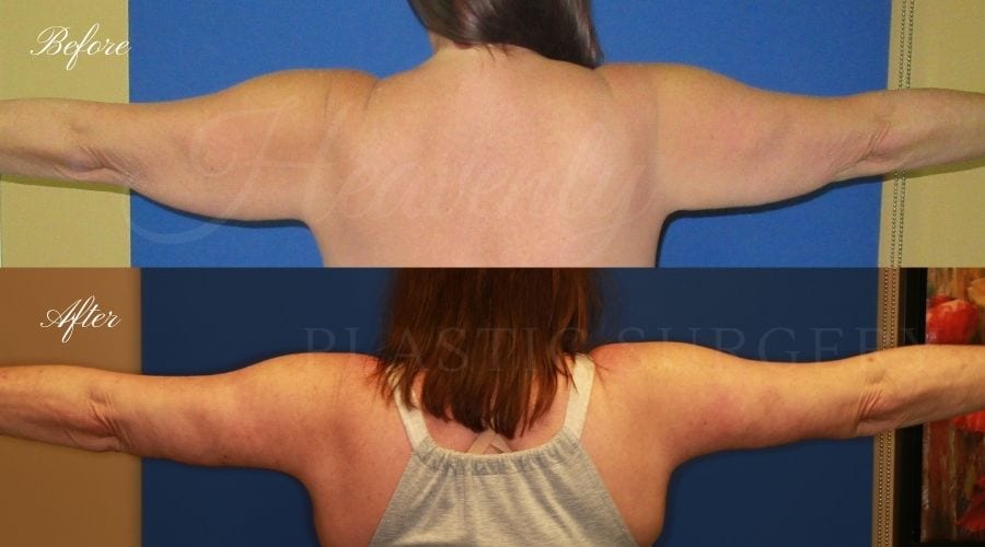 Arm Life Before and After - Back LEMO Plastic Surgery, plastic surgeon, mommy makeover, arm lift, abdominoplasty, brachioplasty, extra skin