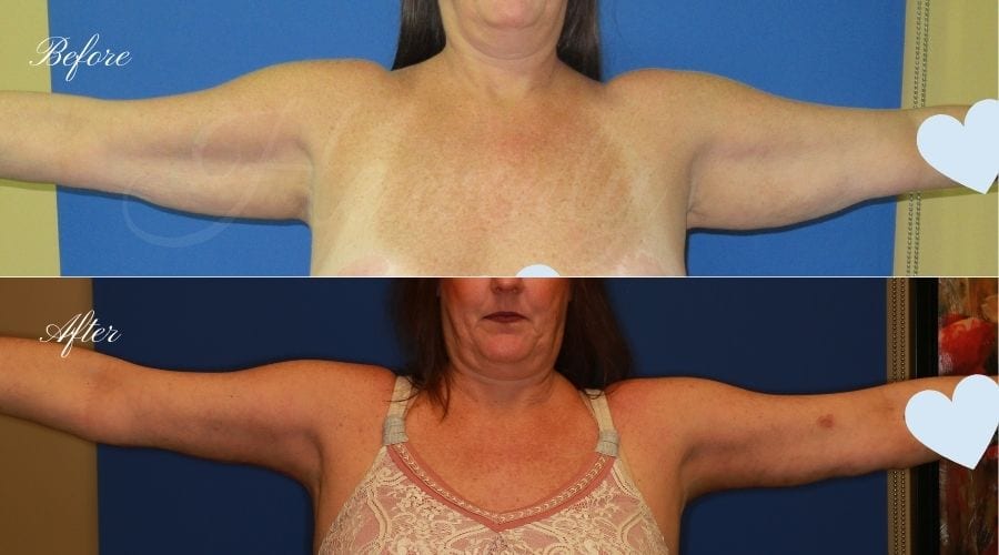 Plastic Surgery, plastic surgeon, arm lift, brachioplasty Plastic Surgery, plastic surgeon, arm lift, brachioplasty
