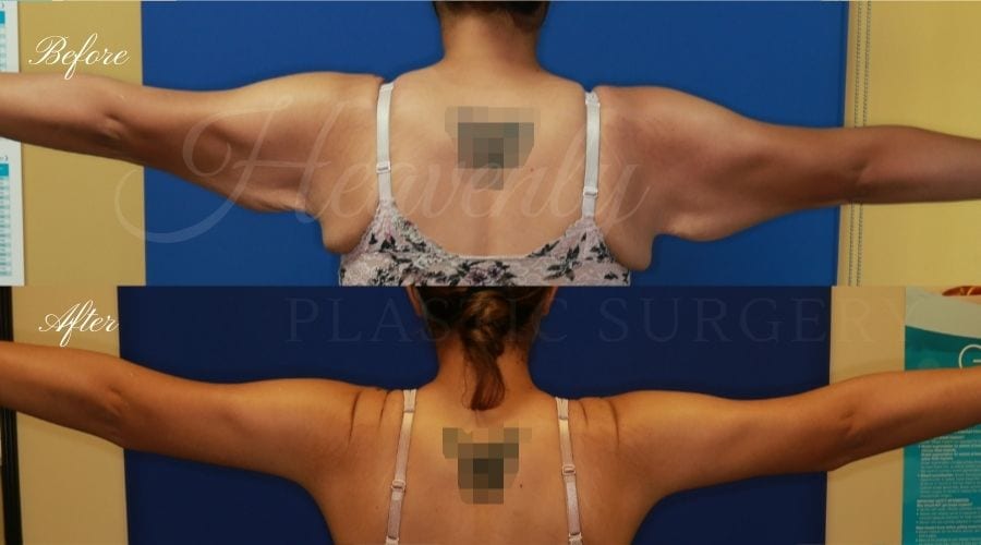 Arm Lift Before and After - Back ARCA Plastic Surgery, plastic surgeon, mommy makeover, arm lift, abdominoplasty, brachioplasty, extra skin