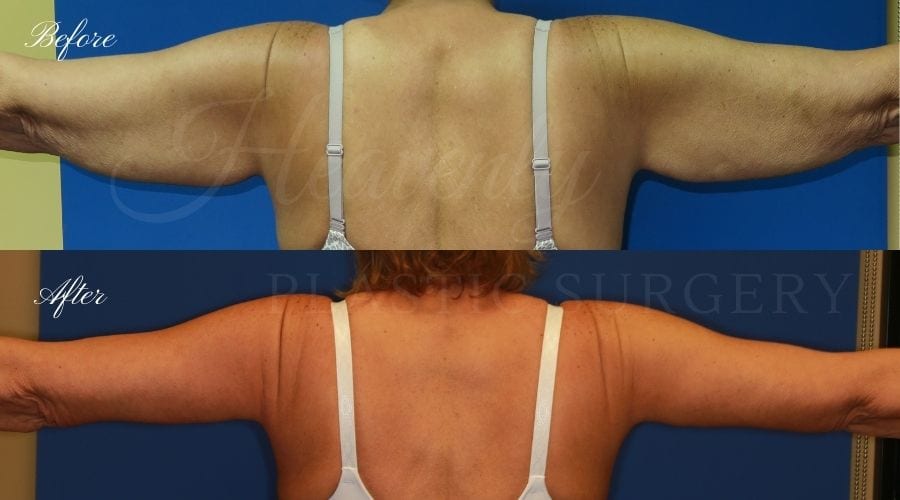 Arm lift, Brachioplasty, plastic surgery, plastic surgeon, massive weight loss