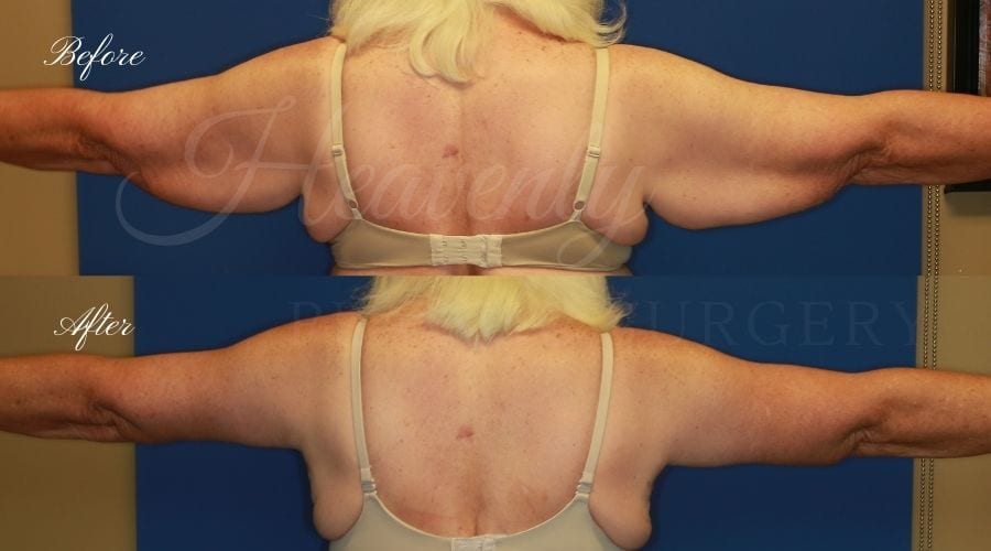 Plastic Surgery, plastic surgeon, mommy makeover, arm lift, abdominoplasty, brachioplasty, extra skin