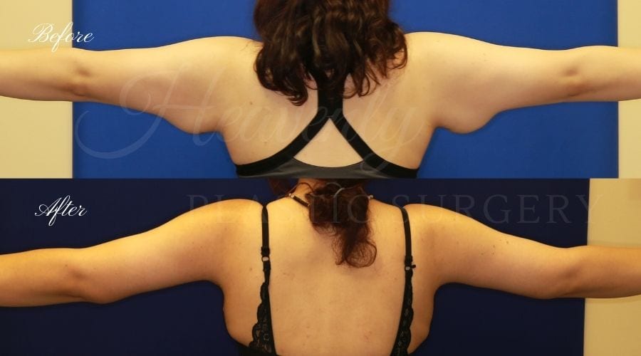 Plastic Surgery, plastic surgeon, mommy makeover, arm lift, abdominoplasty, brachioplasty, extra skin Plastic Surgery, plastic surgeon, mommy makeover, arm lift, abdominoplasty, brachioplasty, extra skin