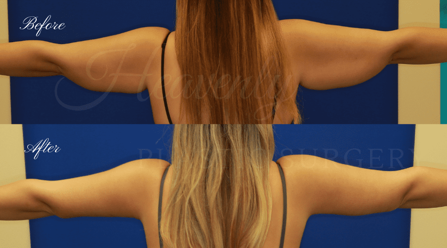 Plastic Surgery, Mommy Makeover, Tummy Tuck, Abdominoplasty, Liposuction, Arm Lift Plastic Surgery, Mommy Makeover, Tummy Tuck, Abdominoplasty, Liposuction, Arm Lift