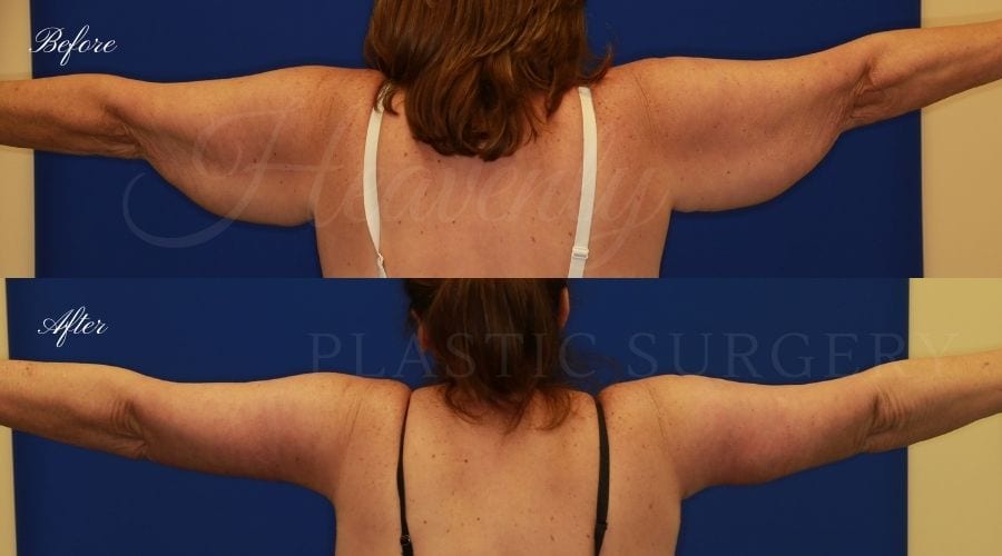 arm lift, extra arm skin, flabby arms, brachioplasty, before and after arm lift, plastic surgery, plastic surgeon, arm lift specialist, arm lift expert