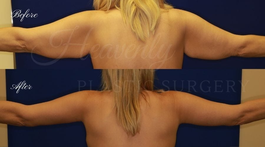 Plastic Surgery, Plastic Surgeon, Tummy Tuck, Arm Lift, Breast Lift, Liposuction