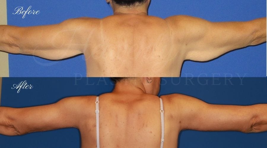 before and after image of a patient in her 50's who had an arm lift / brachioplasty performed by arm lift expert and plastic surgeon Dr. David Nguyen