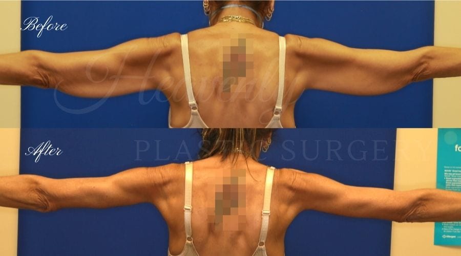 Plastic Surgery, Plastic Surgeon, Tummy Tuck, Arm Lift, Breast Lift, Liposuction Plastic Surgery, Plastic Surgeon, Tummy Tuck, Arm Lift, Breast Lift, Liposuction