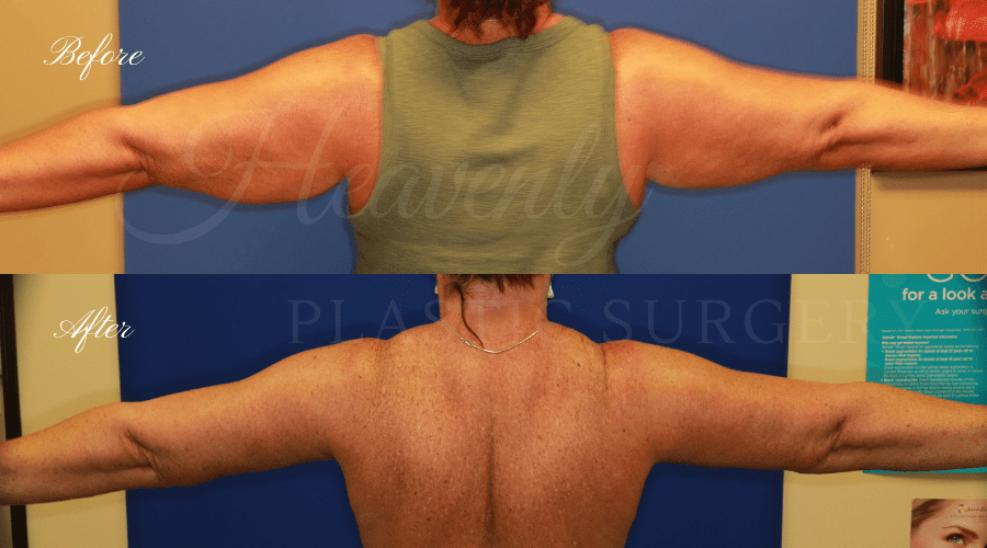 Plastic Surgery, plastic surgeon, mommy makeover, arm lift, abdominoplasty, brachioplasty, extra skin Plastic Surgery, plastic surgeon, mommy makeover, arm lift, abdominoplasty, brachioplasty, extra skin