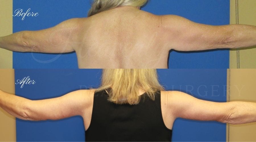 Plastic Surgery, plastic surgeon, arm lift, brachioplasty Plastic Surgery, plastic surgeon, arm lift, brachioplasty